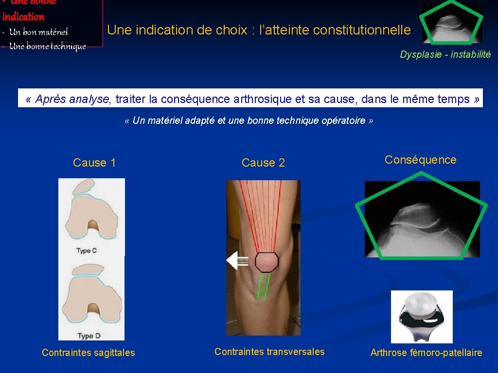 - Une bonne indication - Un bon matériel - Une bonne technique Une indication