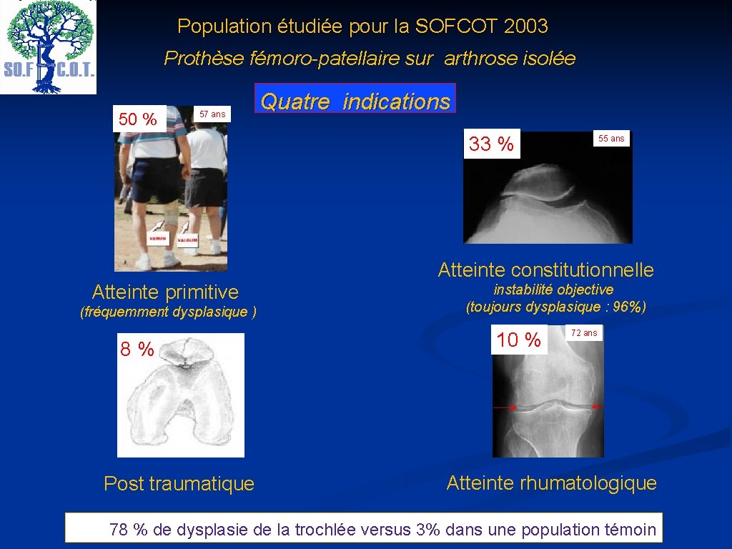 Population étudiée pour la SOFCOT 2003 Prothèse fémoro-patellaire sur arthrose isolée 50 % 57