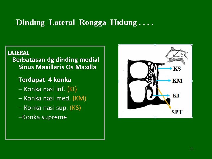 Dinding Lateral Rongga Hidung. . LATERAL Berbatasan dg dinding medial Sinus Maxillaris Os Maxilla