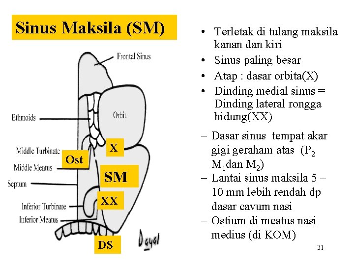 Sinus Maksila (SM) Ost X SM XX DS • Terletak di tulang maksila kanan