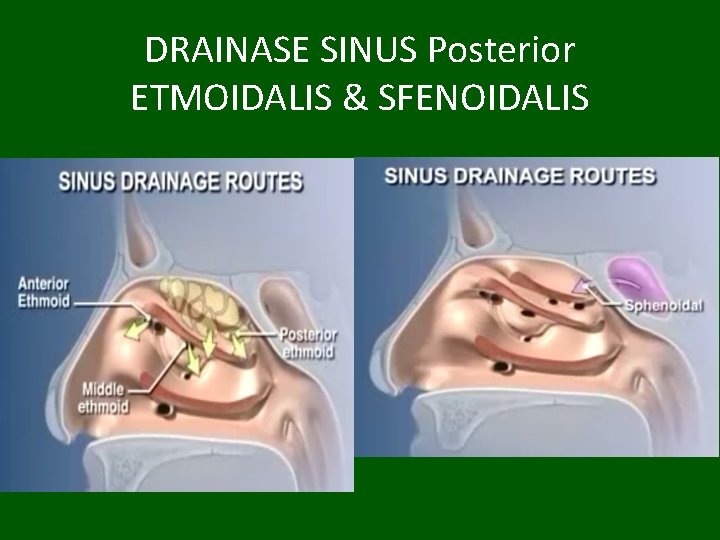 DRAINASE SINUS Posterior ETMOIDALIS & SFENOIDALIS 