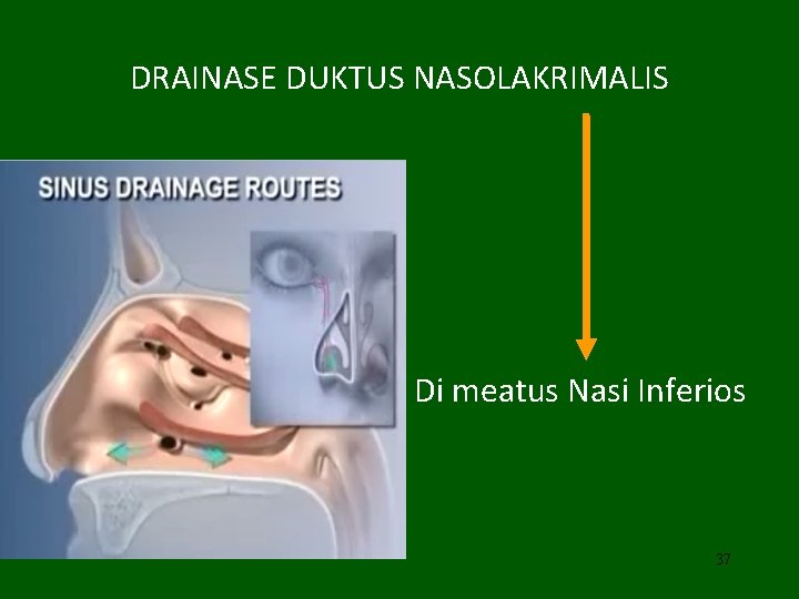 DRAINASE DUKTUS NASOLAKRIMALIS Di meatus Nasi Inferios 37 
