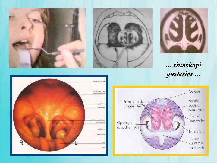 . . . rinoskopi posterior. . . 