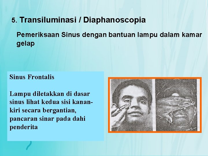 5. Transiluminasi / Diaphanoscopia Pemeriksaan Sinus dengan bantuan lampu dalam kamar gelap Sinus Frontalis