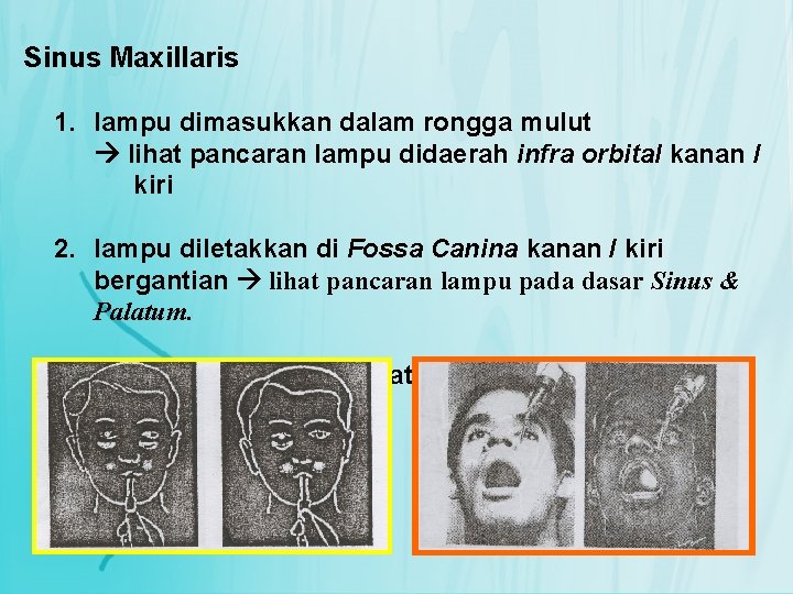 Sinus Maxillaris 1. lampu dimasukkan dalam rongga mulut lihat pancaran lampu didaerah infra orbital