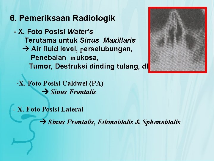 6. Pemeriksaan Radiologik - X. Foto Posisi Water’s Terutama untuk Sinus Maxillaris Air fluid