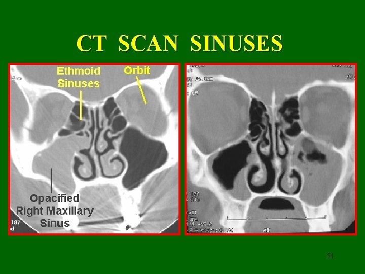 CT SCAN SINUSES 51 