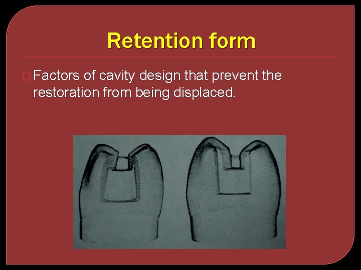 Retention form � Factors of cavity design that prevent the restoration from being displaced.