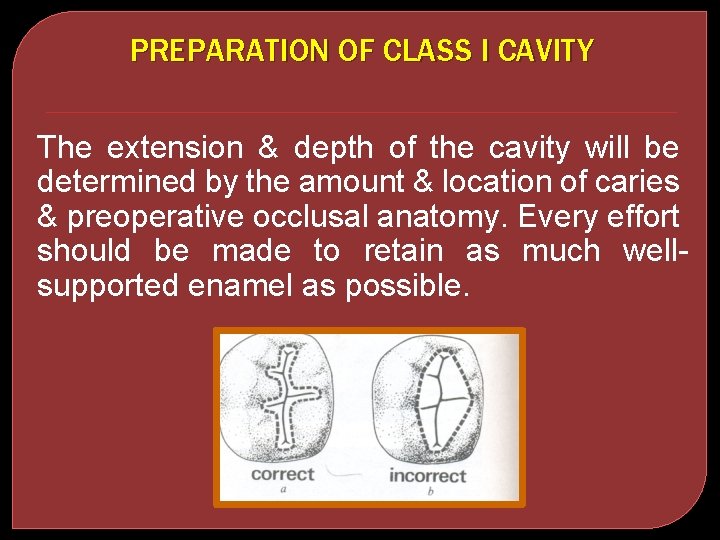 PREPARATION OF CLASS I CAVITY The extension & depth of the cavity will be