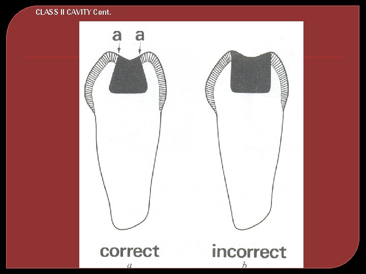 CLASS II CAVITY Cont. 