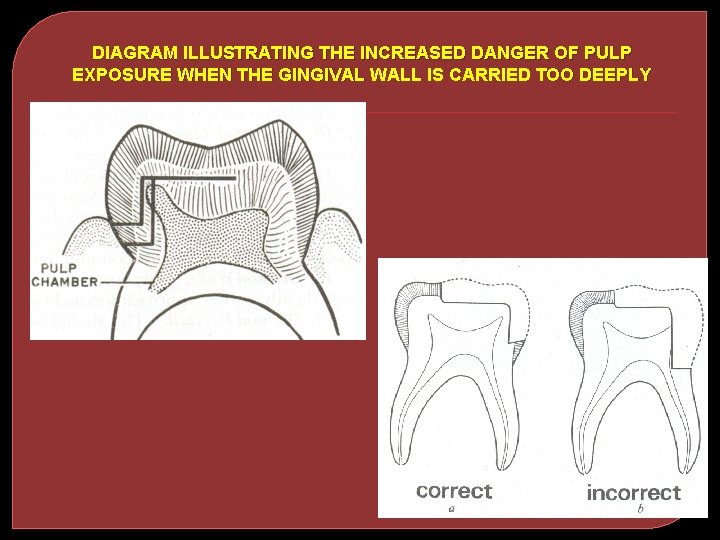 DIAGRAM ILLUSTRATING THE INCREASED DANGER OF PULP EXPOSURE WHEN THE GINGIVAL WALL IS CARRIED