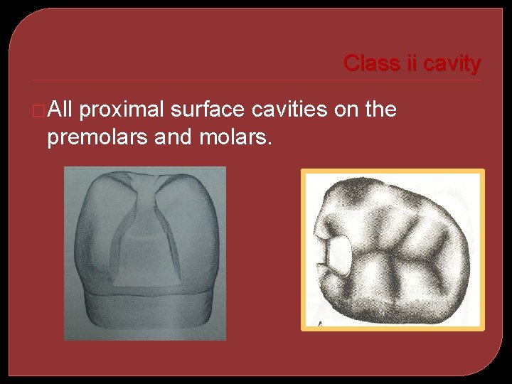 Class ii cavity �All proximal surface cavities on the premolars and molars. 