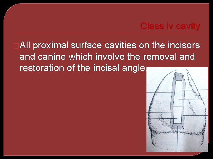 Class iv cavity �All proximal surface cavities on the incisors and canine which involve