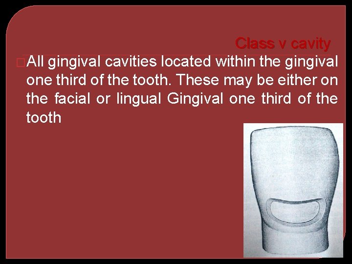 Class v cavity �All gingival cavities located within the gingival one third of the