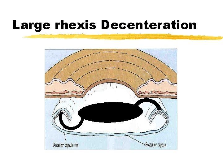 Large rhexis Decenteration 