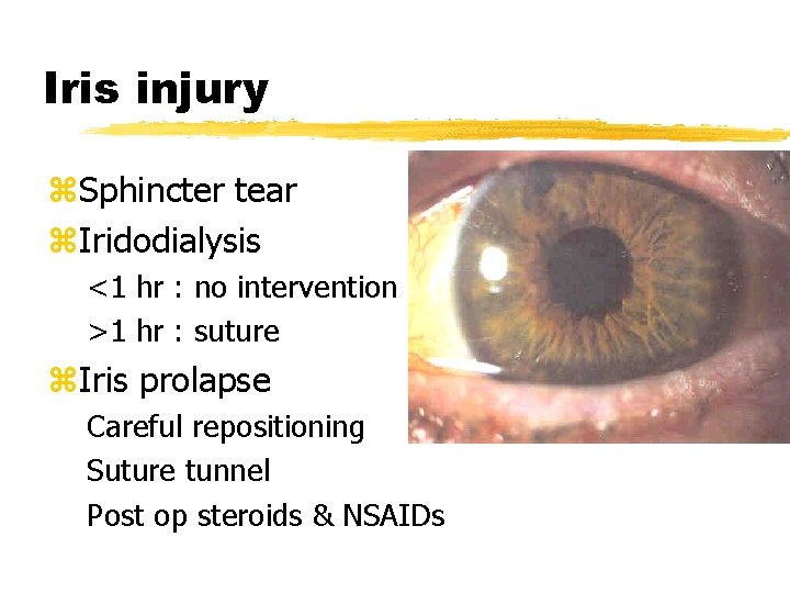 Iris injury z. Sphincter tear z. Iridodialysis <1 hr : no intervention >1 hr