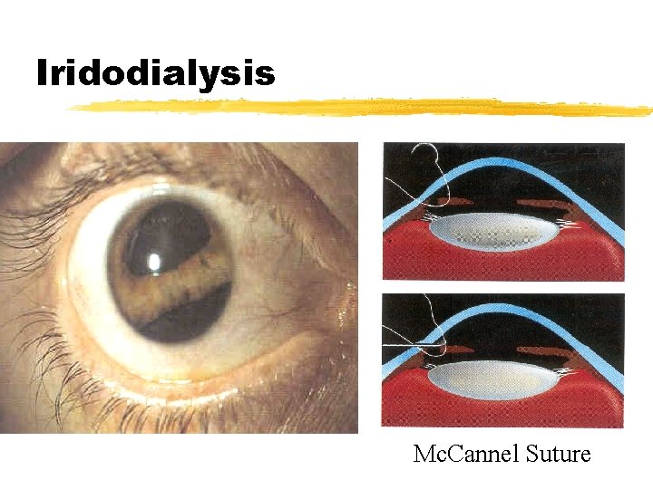 Iridodialysis Mc. Cannel Suture 