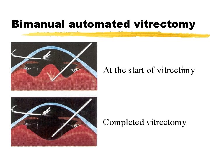 Bimanual automated vitrectomy At the start of vitrectimy Completed vitrectomy 