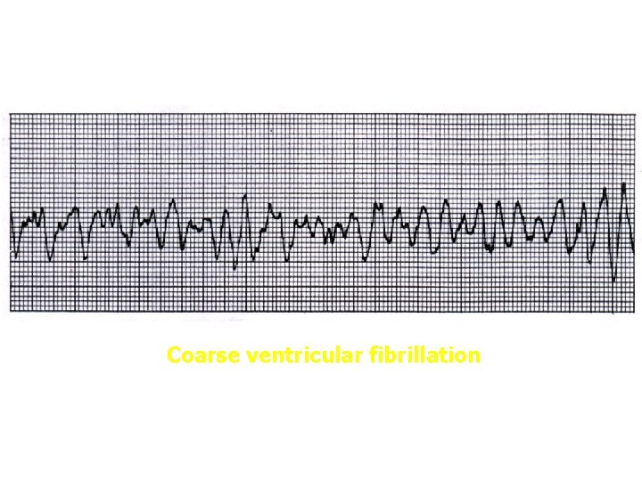 Coarse ventricular fibrillation 