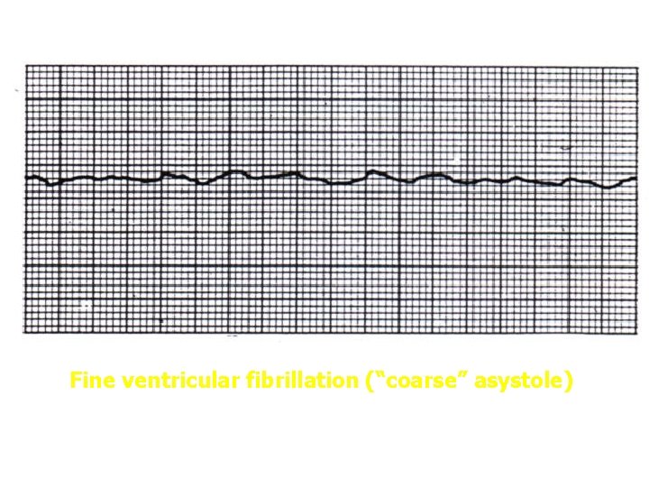 Fine ventricular fibrillation (“coarse” asystole) 