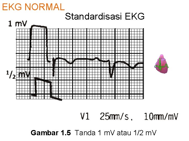 EKG NORMAL Standardisasi EKG Gambar 1. 5 Tanda 1 m. V atau 1/2 m.