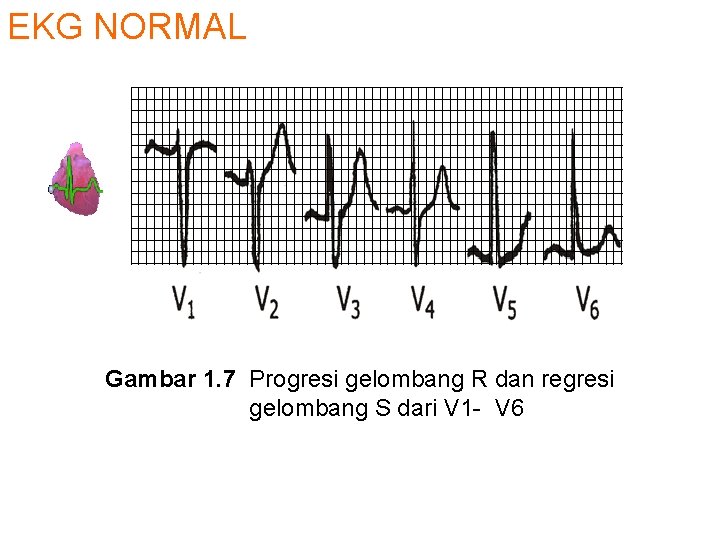 EKG NORMAL Gambar 1. 7 Progresi gelombang R dan regresi gelombang S dari V