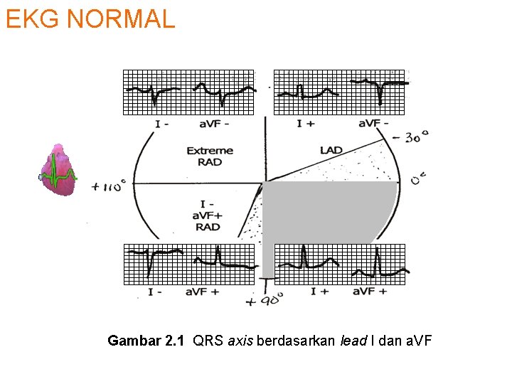 EKG NORMAL Gambar 2. 1 QRS axis berdasarkan lead I dan a. VF 