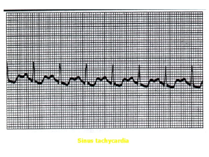 Sinus tachycardia 