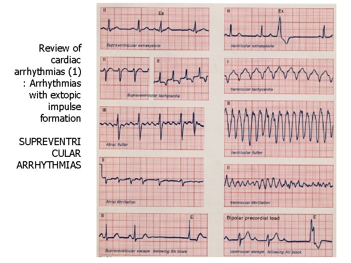 Review of cardiac arrhythmias (1) : Arrhythmias with extopic impulse formation SUPREVENTRI CULAR ARRHYTHMIAS