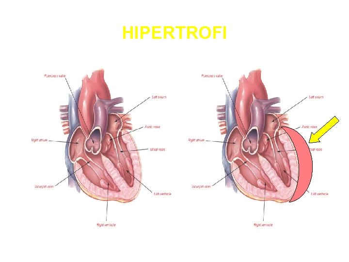 HIPERTROFI 