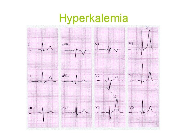 Hyperkalemia 