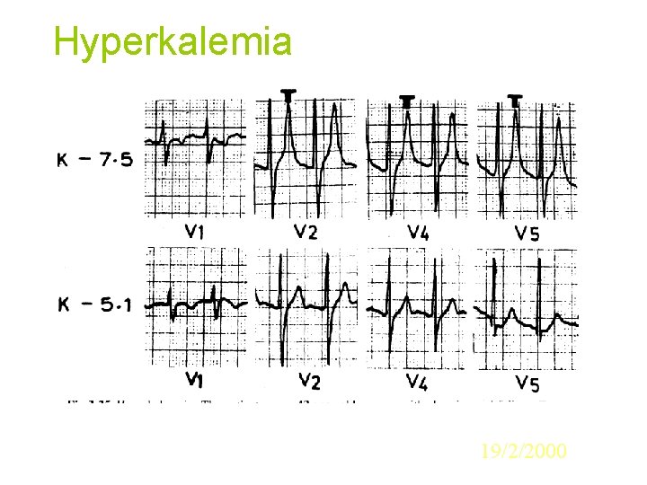 Hyperkalemia 19/2/2000 