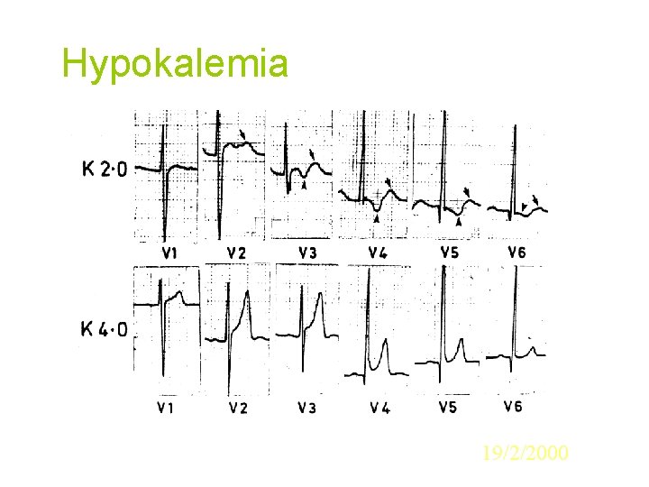 Hypokalemia 19/2/2000 