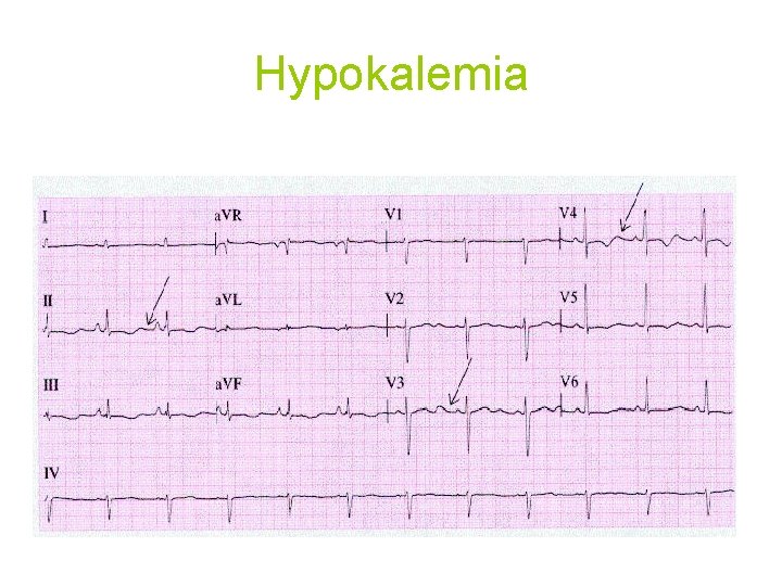 Hypokalemia 