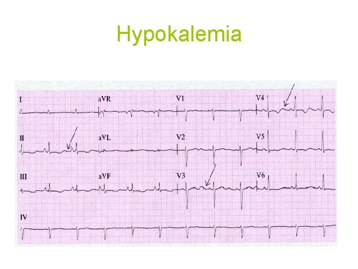 Hypokalemia 