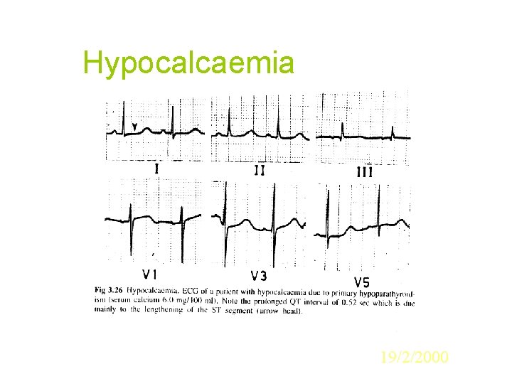 Hypocalcaemia 19/2/2000 