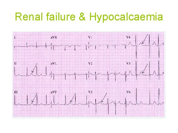 Renal failure & Hypocalcaemia 