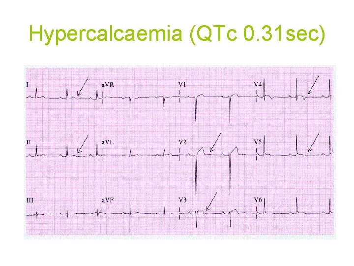 Hypercalcaemia (QTc 0. 31 sec) 