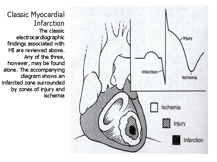 Classic Myocardial Infarction The classic electrocardiographic findings associated with MI are reviewed above. Any