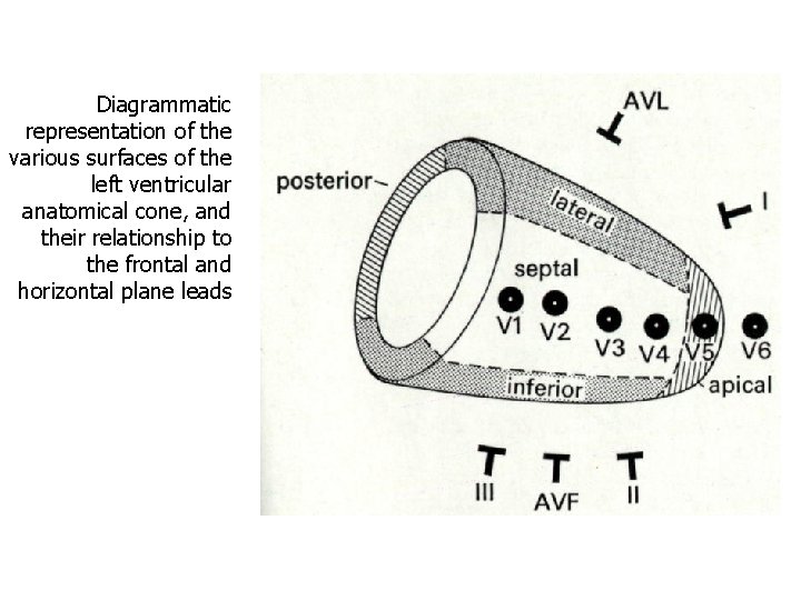 Diagrammatic representation of the various surfaces of the left ventricular anatomical cone, and their