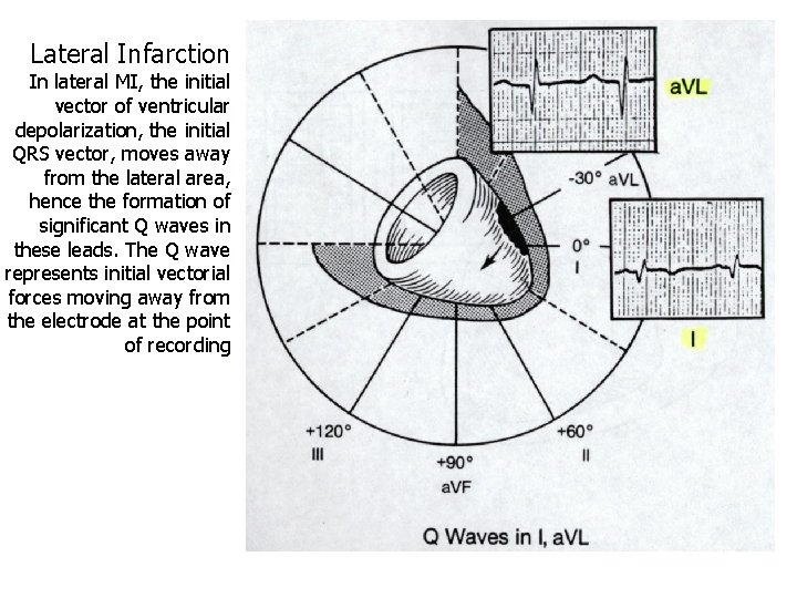 Lateral Infarction In lateral MI, the initial vector of ventricular depolarization, the initial QRS