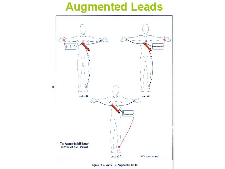 Augmented Leads 