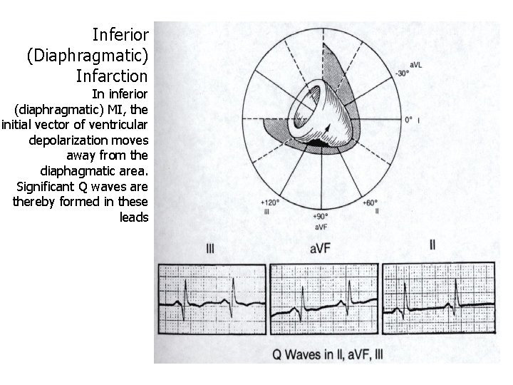 Inferior (Diaphragmatic) Infarction In inferior (diaphragmatic) MI, the initial vector of ventricular depolarization moves
