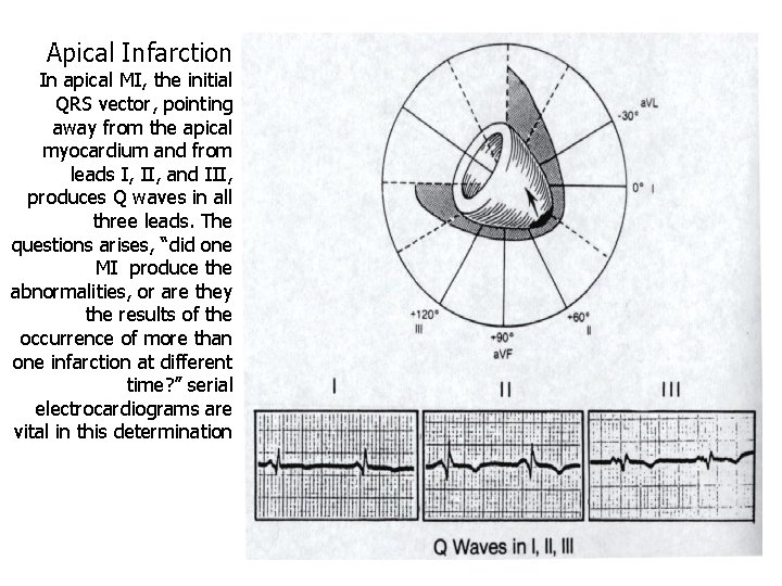 Apical Infarction In apical MI, the initial QRS vector, pointing away from the apical