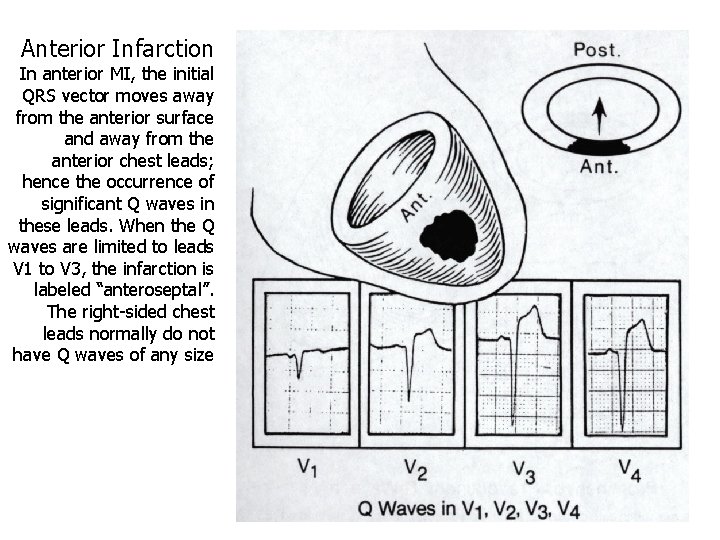 Anterior Infarction In anterior MI, the initial QRS vector moves away from the anterior