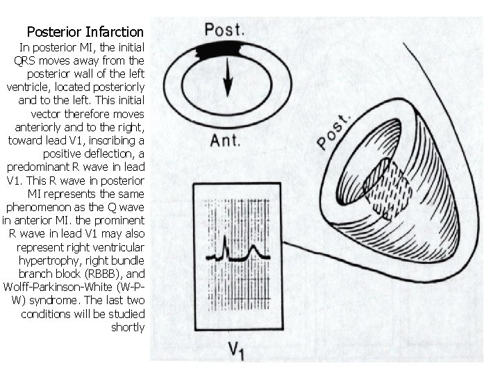 Posterior Infarction In posterior MI, the initial QRS moves away from the posterior wall