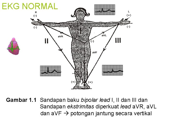 EKG NORMAL Gambar 1. 1 Sandapan baku bipolar lead I, II dan III dan