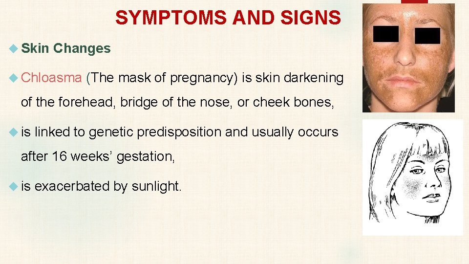 SYMPTOMS AND SIGNS Skin Changes Chloasma (The mask of pregnancy) is skin darkening of