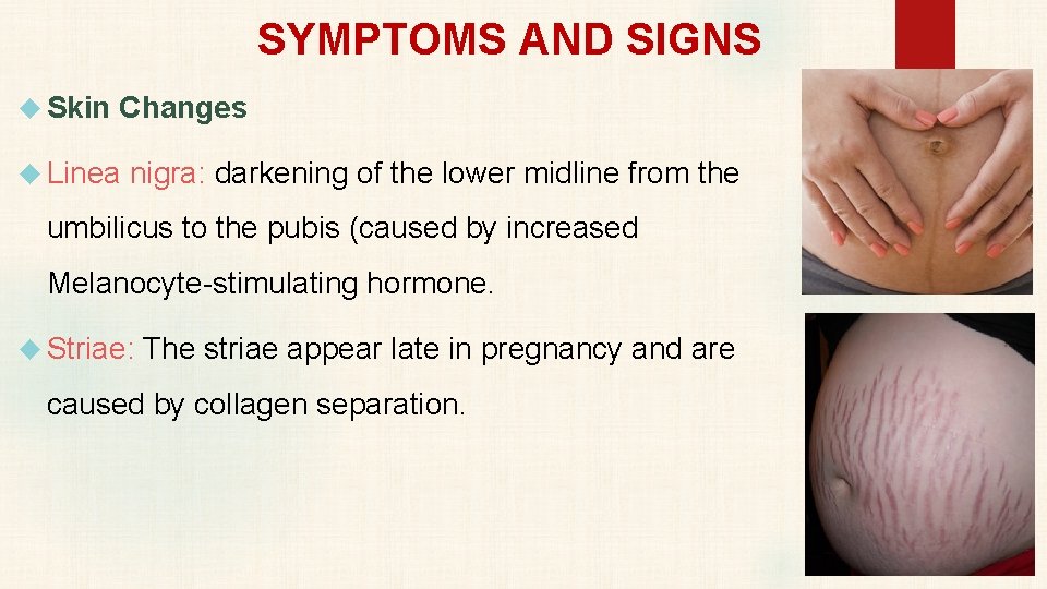 SYMPTOMS AND SIGNS Skin Changes Linea nigra: darkening of the lower midline from the