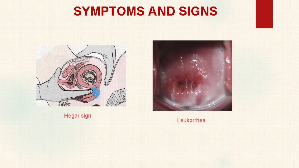 SYMPTOMS AND SIGNS Hegar sign Leukorrhea 